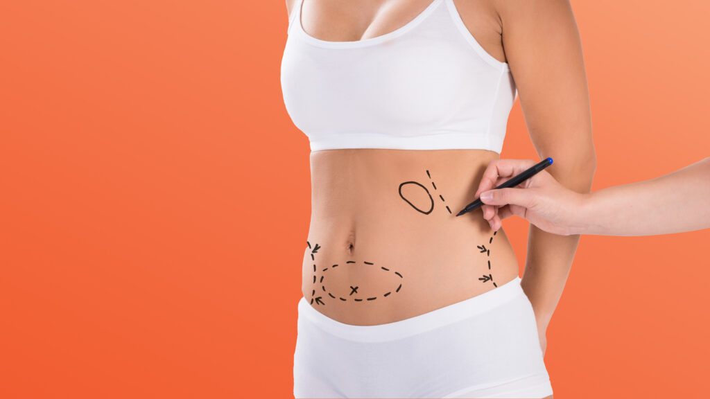 doctor marking areas on woman's abdomen for liposuction surgery