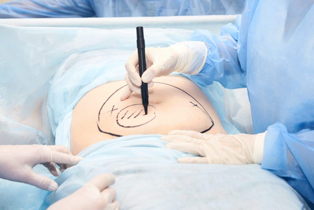 Surgery,Room.,Belly,Surgery.,Doctor,Mark,Liposuction,Area,At,Tummy.