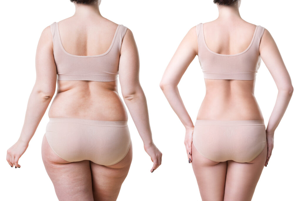 Woman's,Body,Before,And,After,Weight,Loss,Isolated,On,White