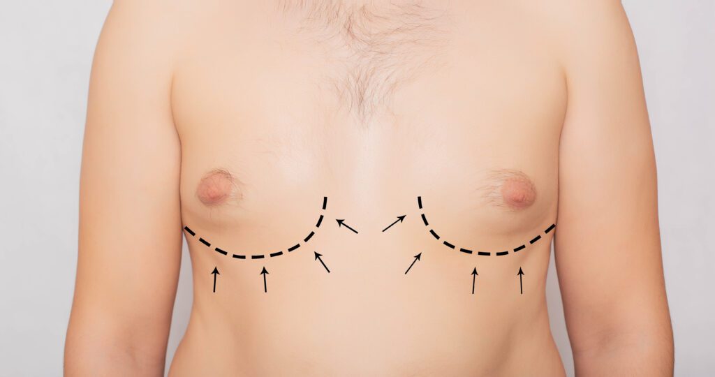 Fat cavitation for male breast